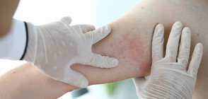 Експерт: Хората с класически алергии могат да проявят реакция и към ваксината