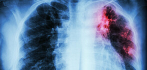 Ръст на случаите на туберкулоза у нас