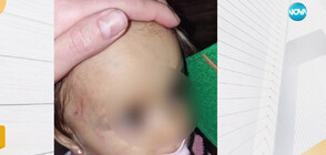 Дете на годинка е с травма на главата след посещение на частна занималня