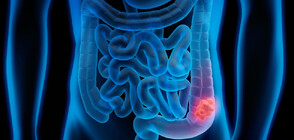 Стратегия срещу рака на дебелото черво: Превенция и диагностика
