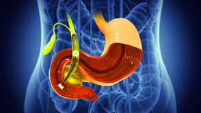Камъни в жлъчката - симптоми, лечение и здравни съвети