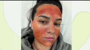 „Билков“ пилинг обезобрази млада майка: Изгаряне втора степен и дълго възстановяване