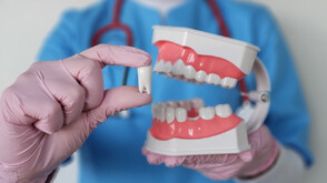 Поставяне на импланти: Всичко, което трябва да знаете