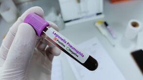 Жена почина от легионерска болест в Бургас