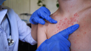 Изследват още деца от Врачанско за морбили