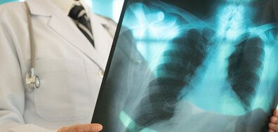 СЗО: Туберкулозата е убила 1,23 милиона души през 2024 година