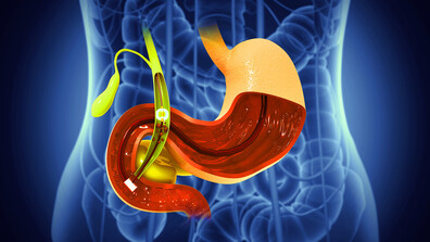 Камъни в жлъчката - симптоми, лечение и здравни съвети