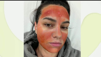 „Билков“ пилинг обезобрази млада майка: Изгаряне втора степен и дълго възстановяване