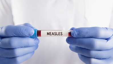 Случаи на морбили и в София, броят на болните расте