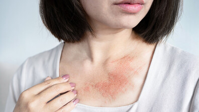 Как влияе затоплянето на времето на хора с дерматологични проблеми