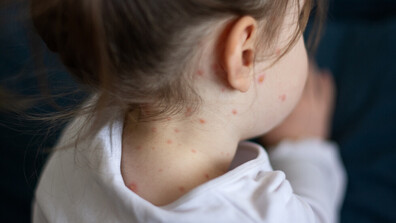 Морбили: Рисковете за възрастните, бременните и пропуските във ваксинацията