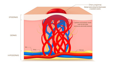 Наследственият ангиоедем - рядко заболяване, често бъркано с алергия