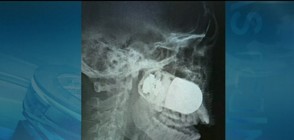 Лекари отстраниха граната от главата на войник (ВИДЕО)