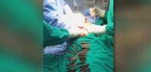 Лекари извадиха 40 джобни ножчета от стомаха на мъж (ВИДЕО)