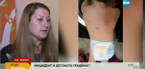 ЕКСПЕРТИЗА: Какво установиха лекарите за нахапаното в Бургас дете?