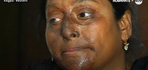 Обезобразени с киселина станаха модели (ВИДЕО)