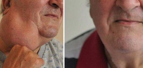 Огромен 20-сантиметров тумор отстраниха от шията на мъж във ВМА