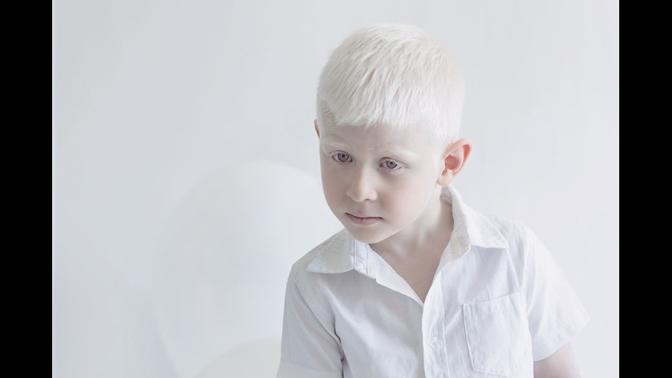 Красотата на хората албиноси